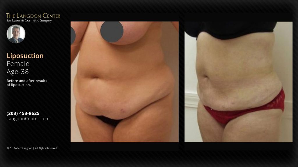 A 38 year old woman had liposuction at the langdon center for laser & cosmetic surgery. There are photos comparing her abdomen before and after the procedure. The picture on the left shows how she looked before. The one on the right shows her improved appearance post liposuction.