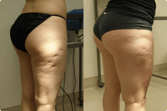 Cellulaze guilford