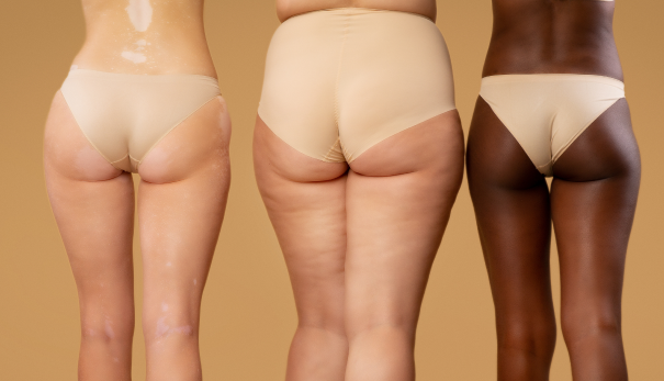 Cellulite guilford