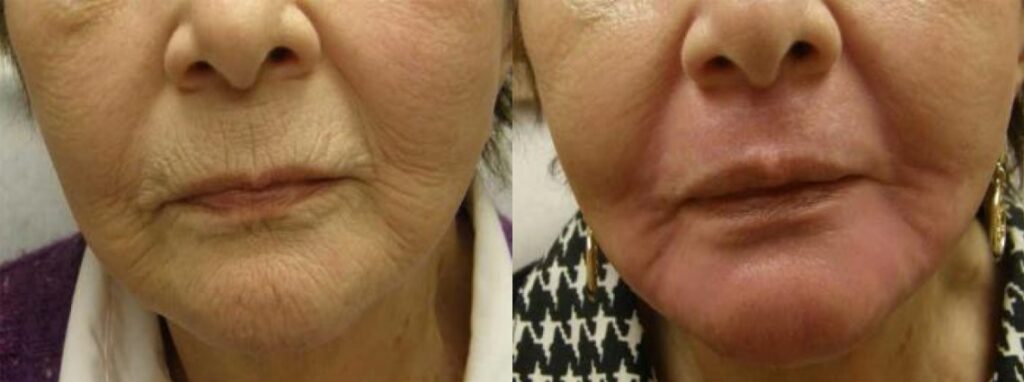 Laser skin resurfacing guilford