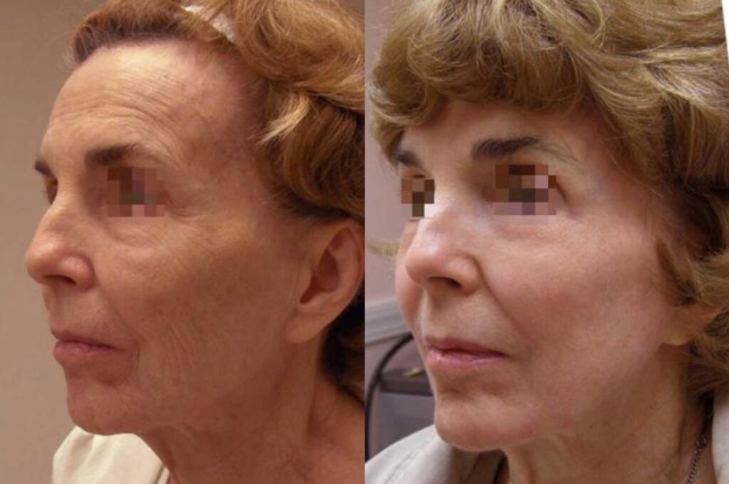 Laser skin resurfacing guilford