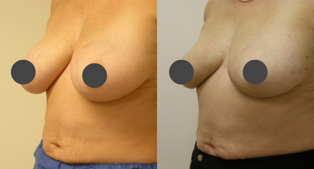 Recovery After Breast Reduction Surgery