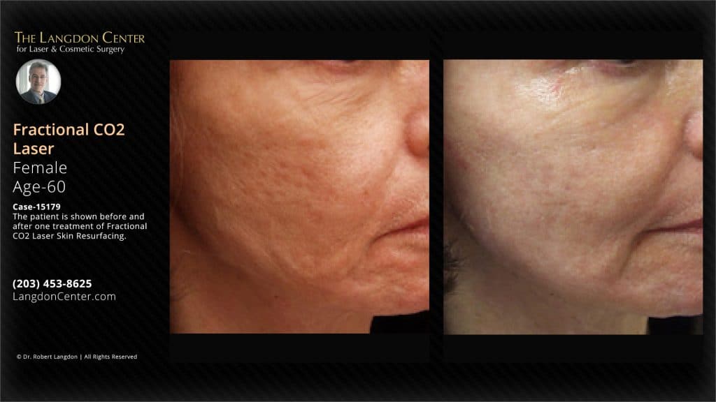 The langdon center for laser & cosmetic surgery carried out fractional co2 laser skin resurfacing on a 60-year-old woman. The pictures display the condition of the patient's skin before and after the treatment, showcasing the enhancement in skin appearance post-procedure.