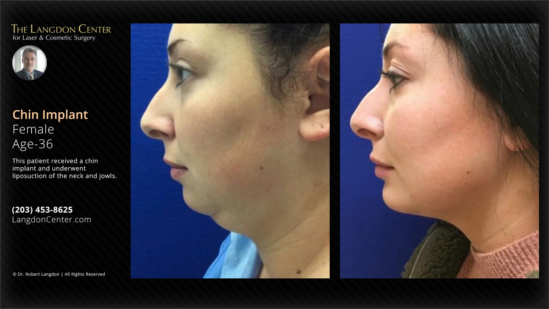 Pictures showing the results of a chin implant surgery on a year-old woman. The first picture displays her profile before the procedure, revealing her chin. In the picture taken after the surgery, her chin and jawline appear defined. The images also feature information about the langdon center for laser & cosmetic surgery, such as contact details and a small photo of dr. Robert langdon.